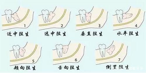 發(fā)炎的智齒什么時候拔才好？有些情況不能拔