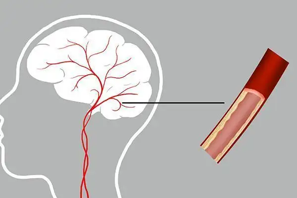 提醒中老年人：腦供血不足時(shí)，身體會(huì)發(fā)出4個(gè)信號(hào)！該如何治療？